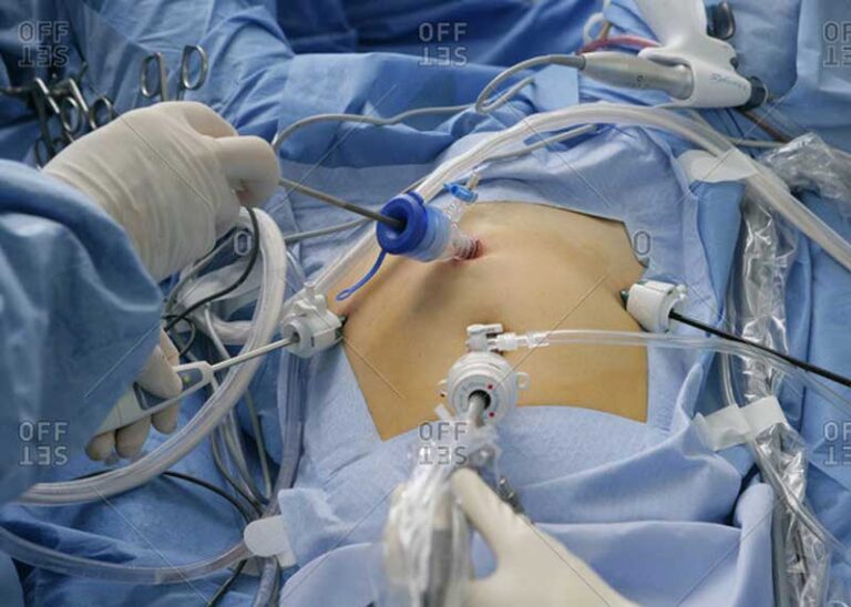 Myomectomy